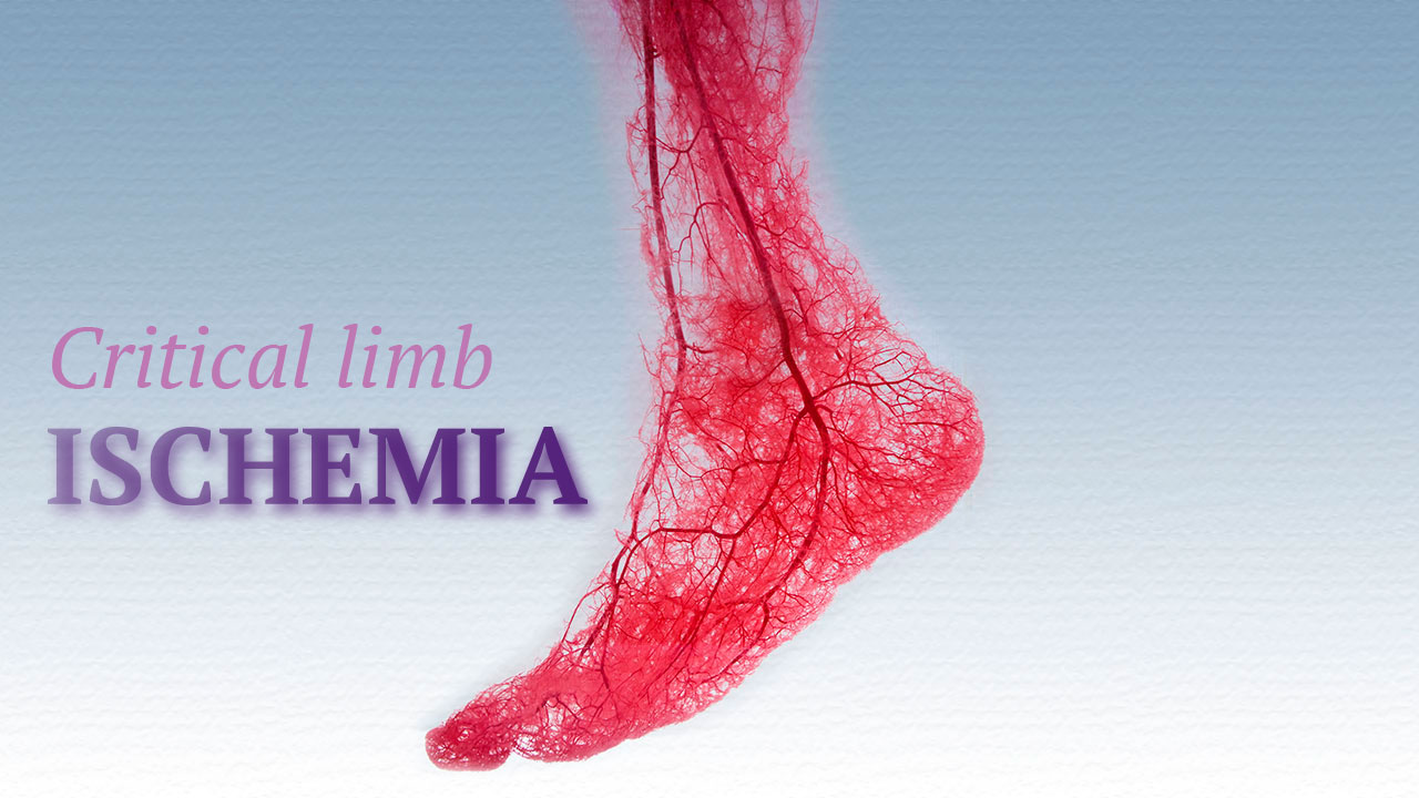 Injection of ETV-2 and HGF genes can rescue the hindlimb ischemia